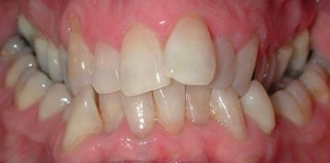 cross bite posteriore