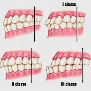 maleocclusioni di classe molare